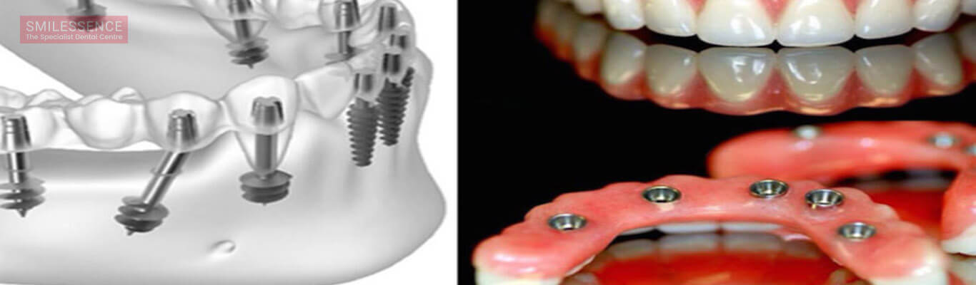 A Comprehensive Guide to Basal Implants