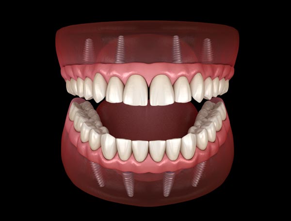 The Whole Guide to Preserving Dentures Supported by Implants  - Dr Vineet Vinayak