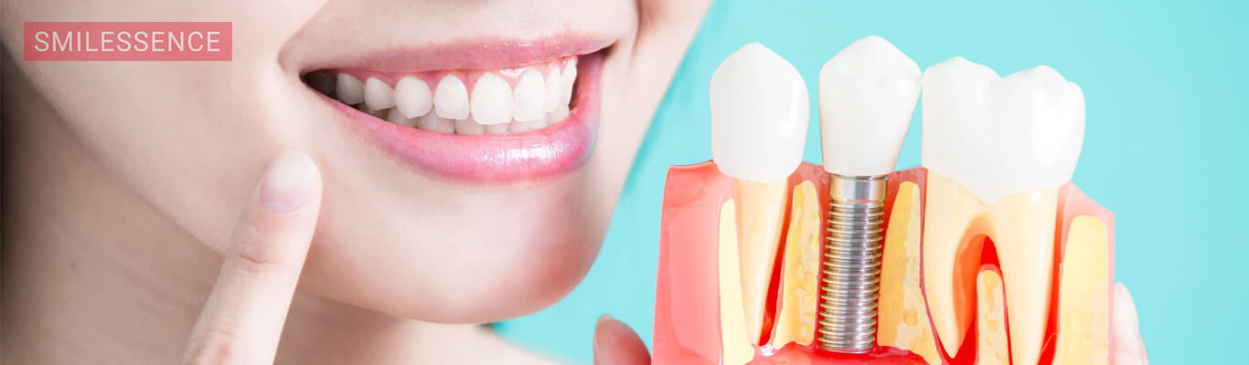 What Makes Smilessence the Best Dental Implant Clinic?