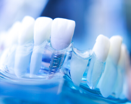 How to Choose the Best Dentist near you for Dental Implants?