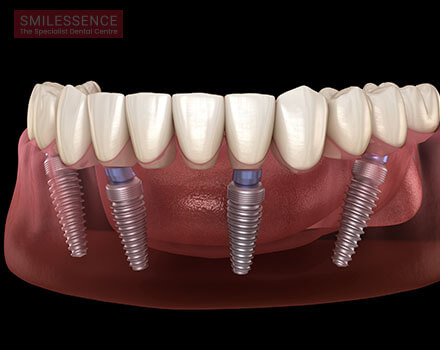 Dental Implants in Gurgaon: All on Four Implants