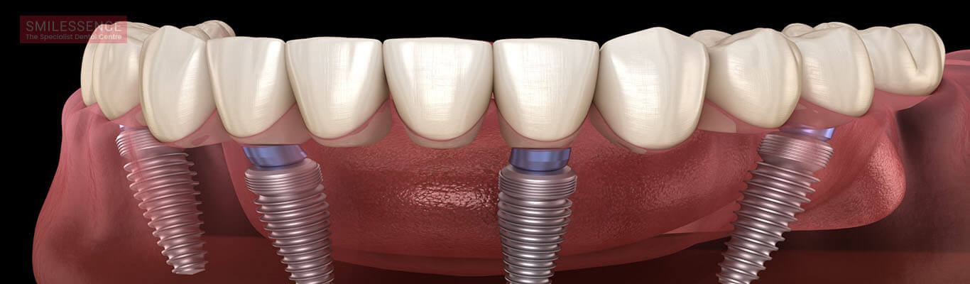 Dental Implants in Gurgaon: All on Four Implants