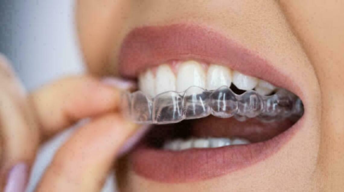 Everything You Need to Know Before Starting Clear aligners.....