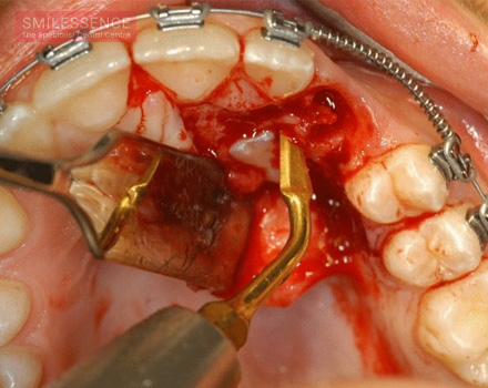 Extraction of Impacted Maxillary Canine with Simultaneous Implant Placement