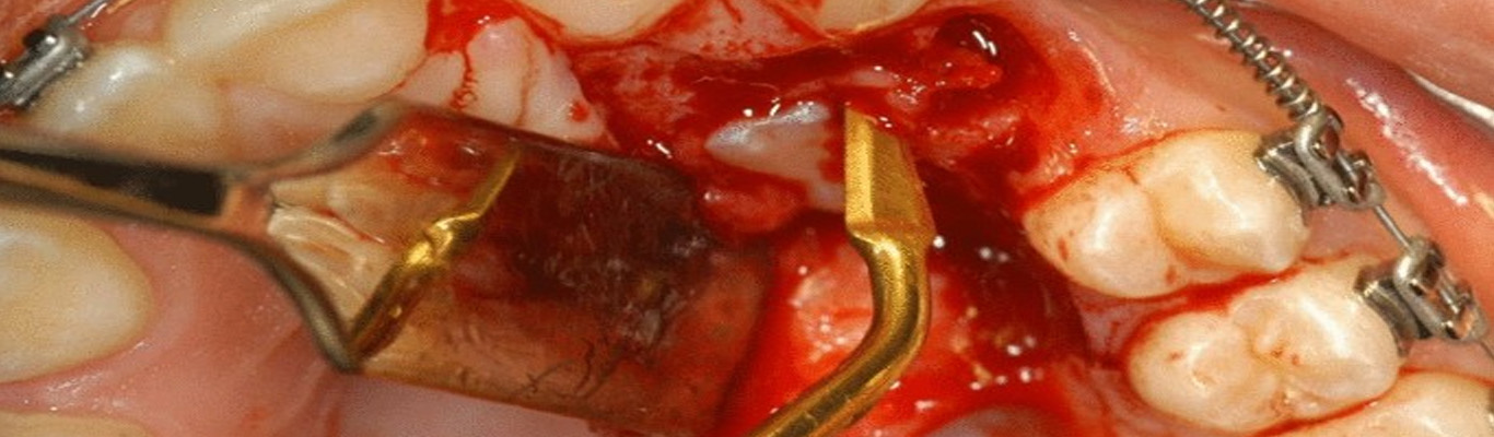 Extraction of Impacted Maxillary Canine with Simultaneous Implant Placement