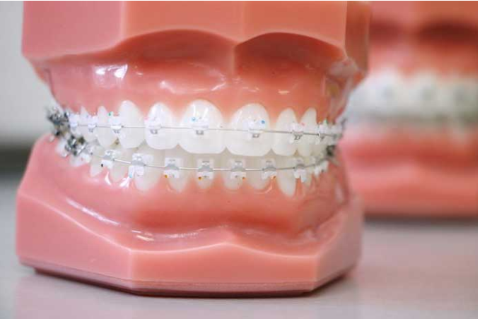 Faster, Gentler, Better: The Benefits of Self Ligating Metal Damon Braces