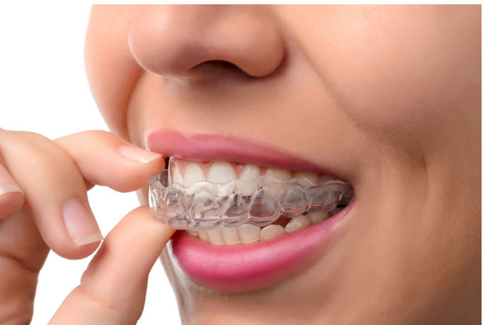 Invisalign Alligners; the Invisible braces...