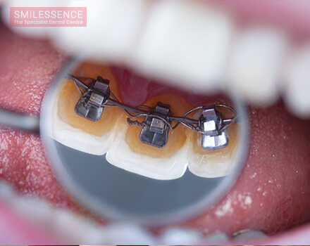 Lingual braces - The Invisible Braces