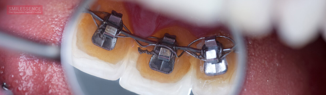 Lingual braces - The Invisible Braces