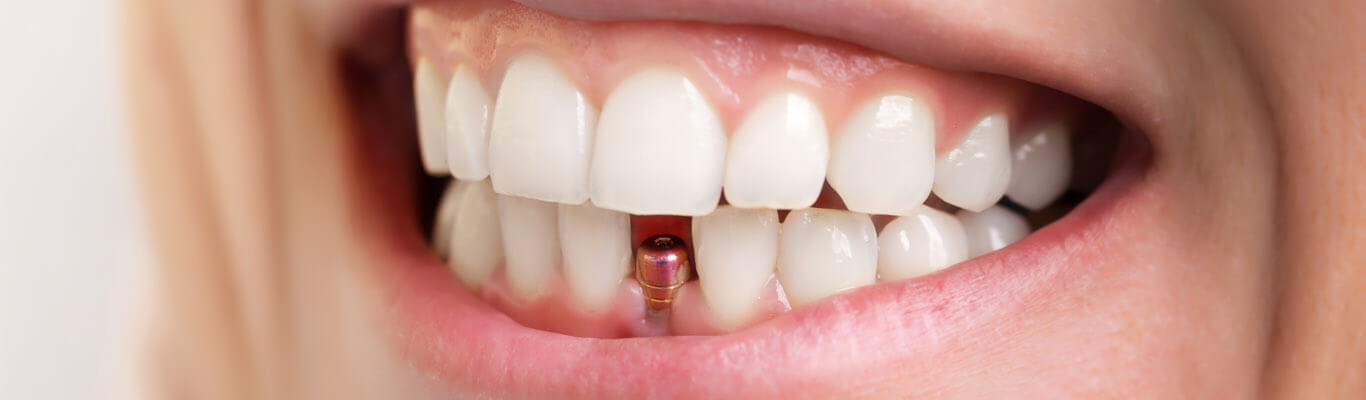 Reasons to Opt For Dental Implants