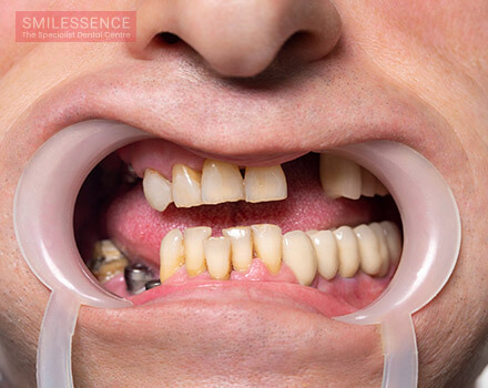 What are the Tooth Replacement Options Available?