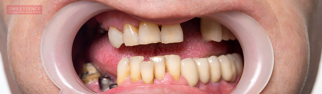 What are the Tooth Replacement Options Available?