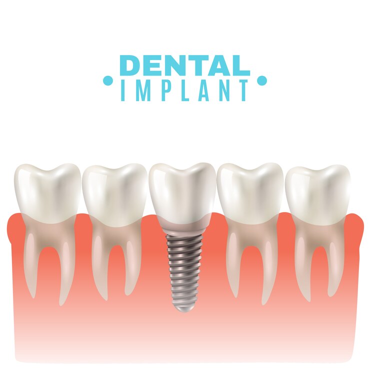 Transform Your Smile with All-on-4 Dental Implants in Gurgaon
