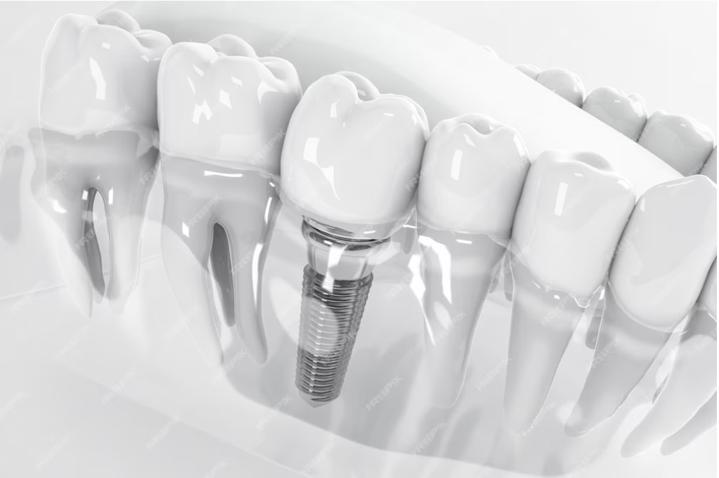Unveiling the Allure of Dental Implants: 5 Key Reasons behind Their Popularity
