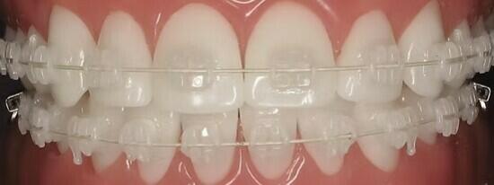 Why Self Ligating Ceramic Braces Are a Smarter Choice?