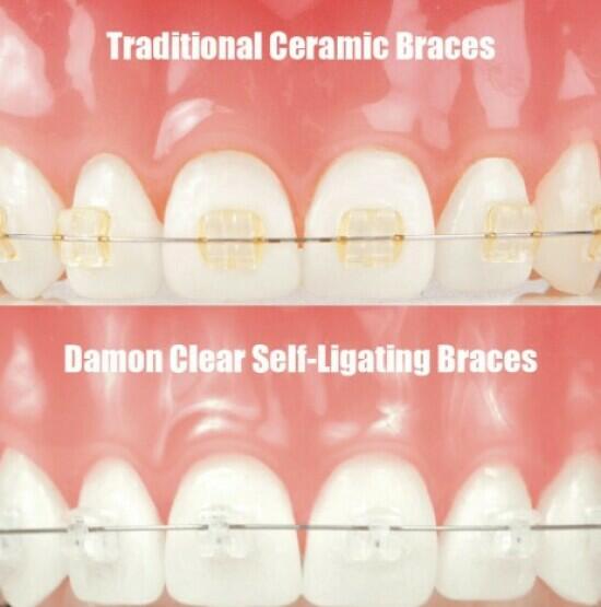 Why Self Ligating Ceramic Braces Are a Smarter Choice?