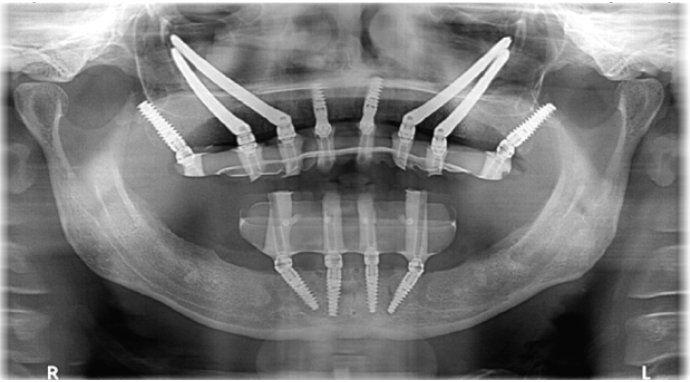 Zygomatic implants.... a Life-Changing Fixed Teeth Solution for Severe Jaw Bone Loss