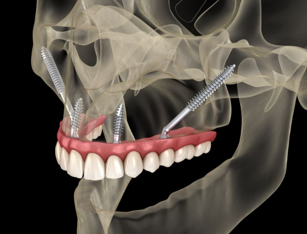 Zygomatic implants.... a Life-Changing Fixed Teeth Solution for Severe Jaw Bone Loss