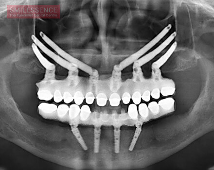 Zygomatic Implants - How to Take Care Post Implantation!