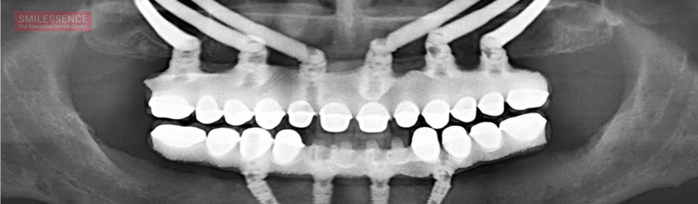 Zygomatic Implants - How to Take Care Post Implantation!