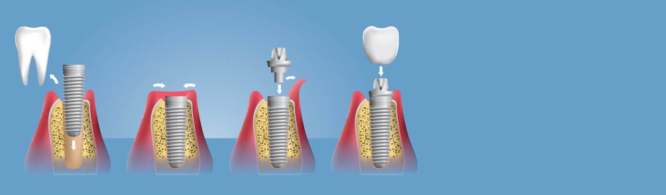All On 6 Dental Implants