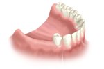 multiple teeth replacement