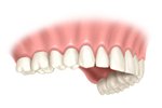 single teeth implant