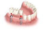 multiple teeth replacement