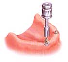 dentures with implants