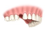 single teeth implant