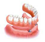 fixing dentures with implants