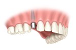 single teeth implant