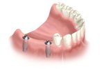 multiple teeth replacement