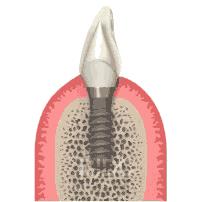 Bone-Level-Implant