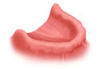 fixing dentures with implants