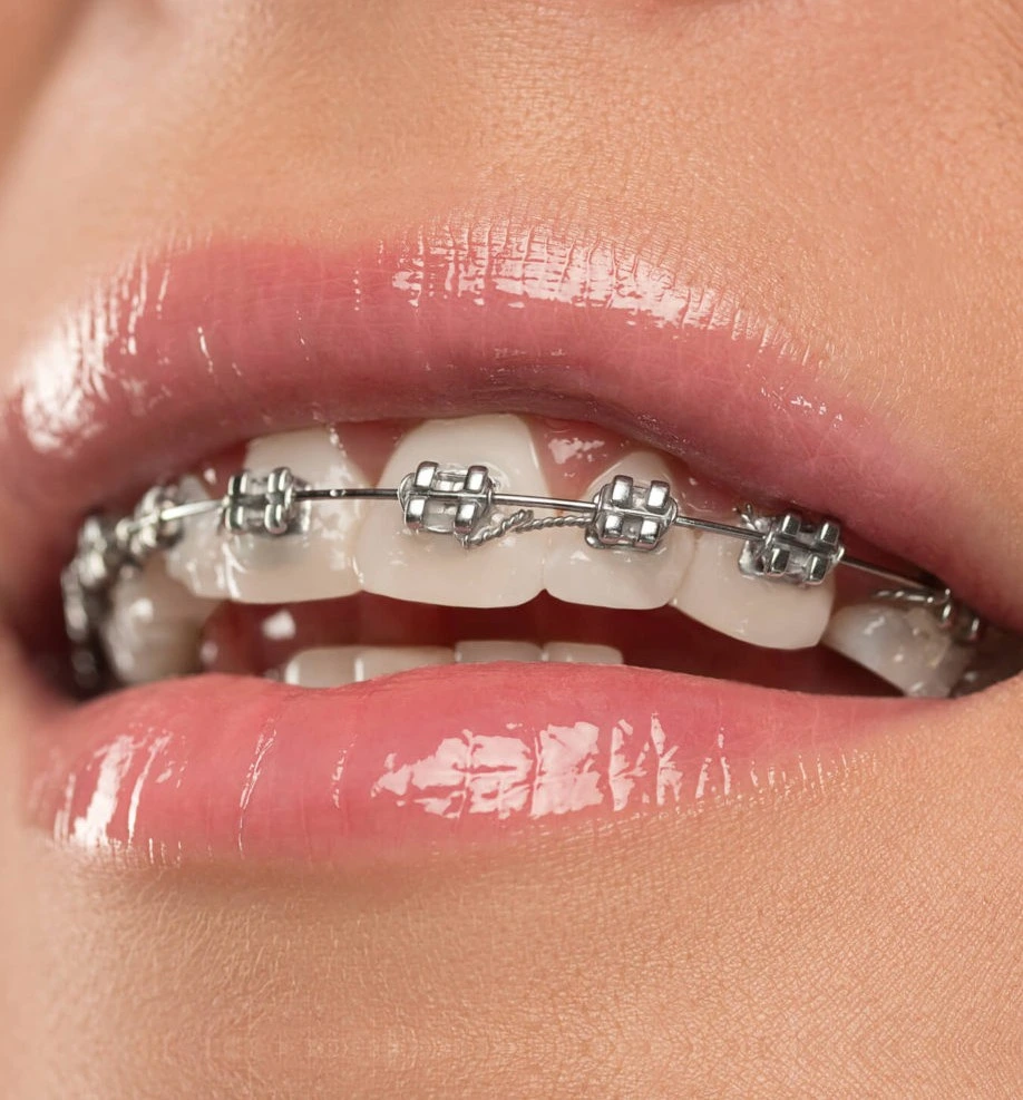Self-Ligating Ceramic Braces