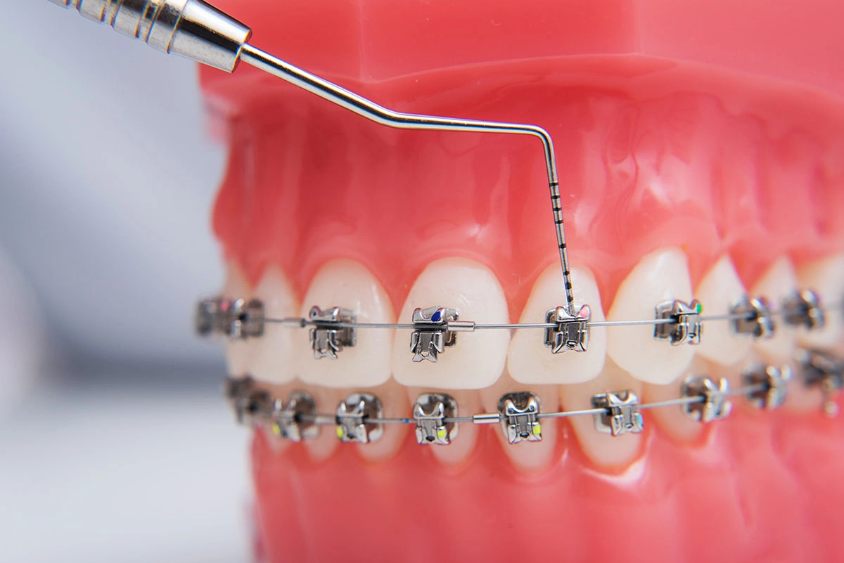 Self-Ligated Metal Braces