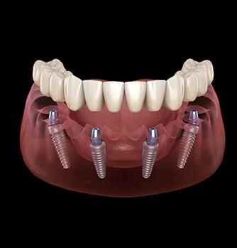 All on 4 Implants