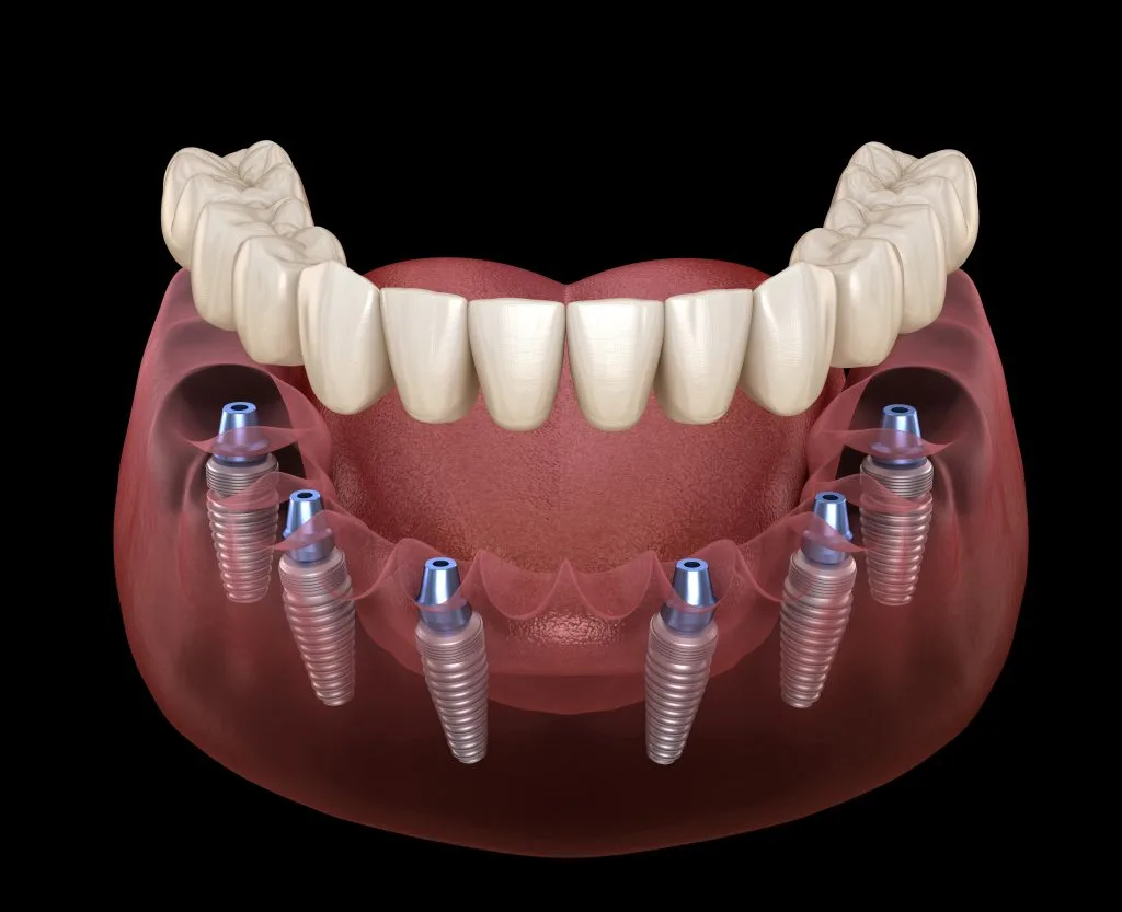 All On 6 Implants