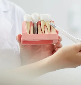 Dental Implants