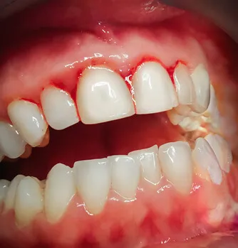 Gum Treatment