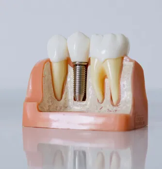 Multiple Teeth Replacement