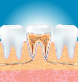 Root Canal